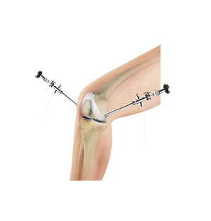 Knee Arthroscopy