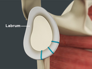  Labrum Repair