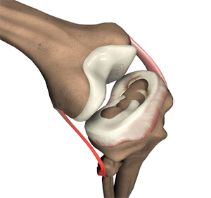 Meniscus Repair