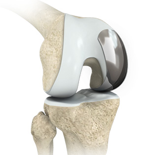 Partial Knee Replacement