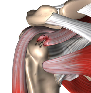 Rotator Cuff Repair