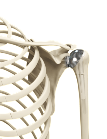 Anatomic Shoulder Replacement