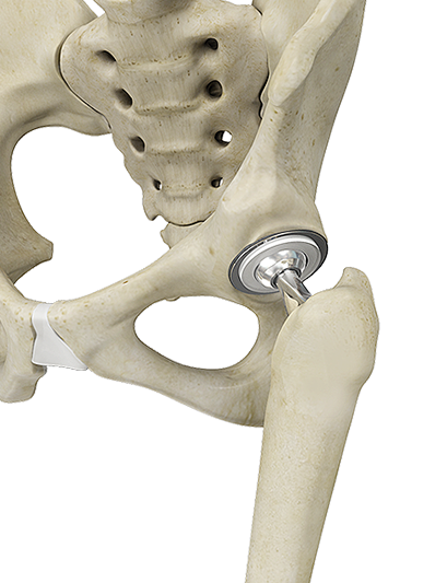 Direct Anterior Approach