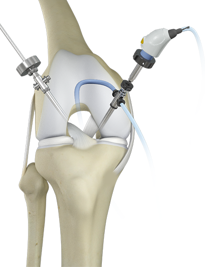 Knee Arthroscopy