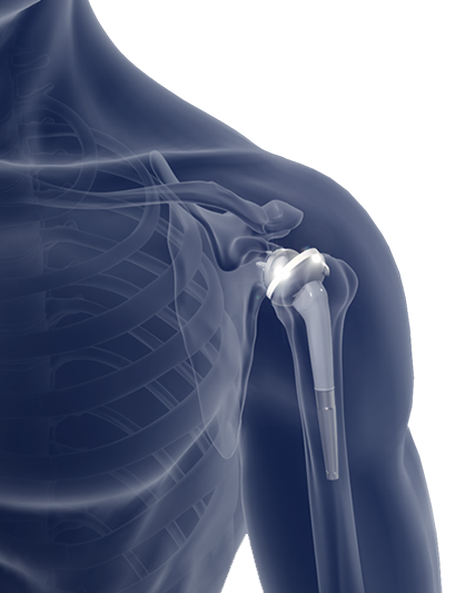 Reverse Shoulder Replacement