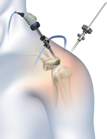 Shoulder Arthroscopy