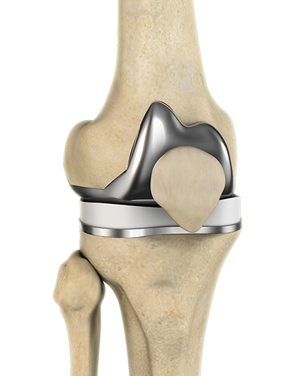 Total Knee Replacement